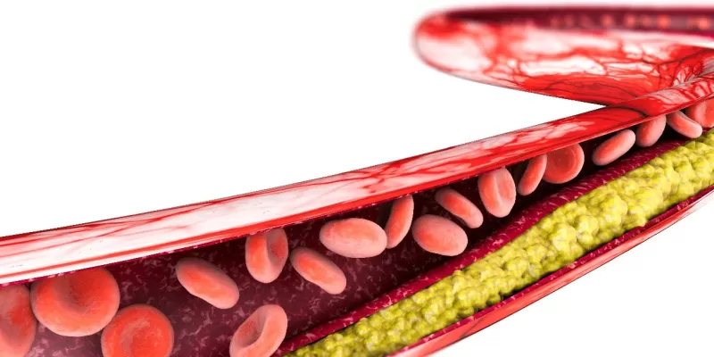 Vaso sanguíneo com placas de gordura 