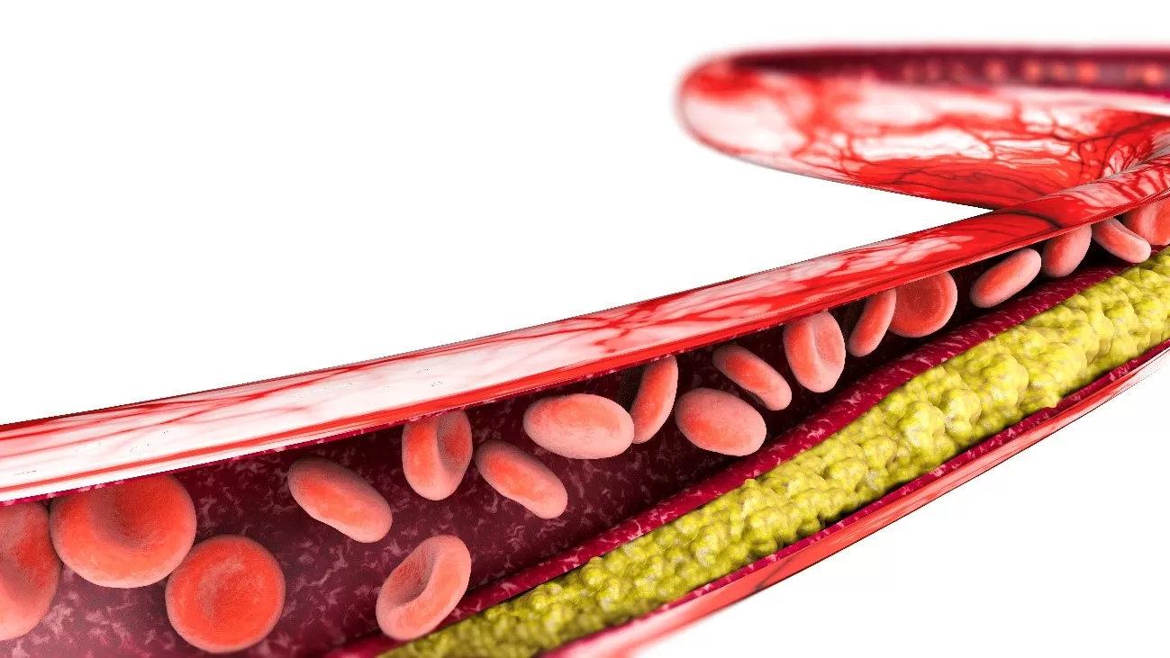 Vaso sanguíneo com placas de gordura 